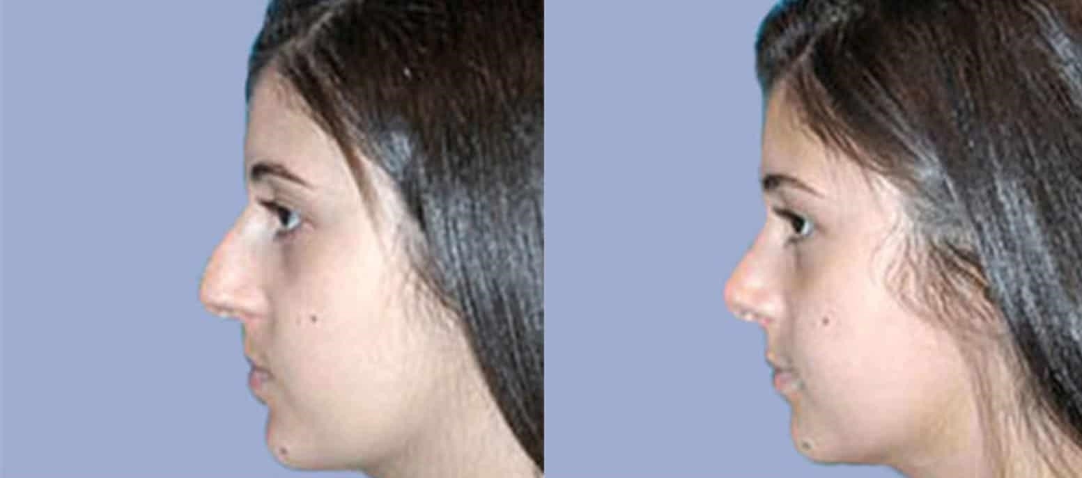 revision rhinoplasty expert los angeles