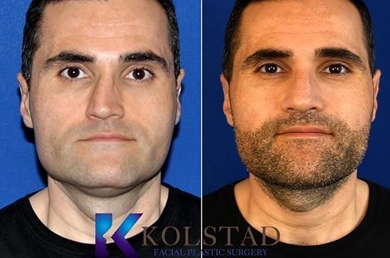 rhinoplasty experts