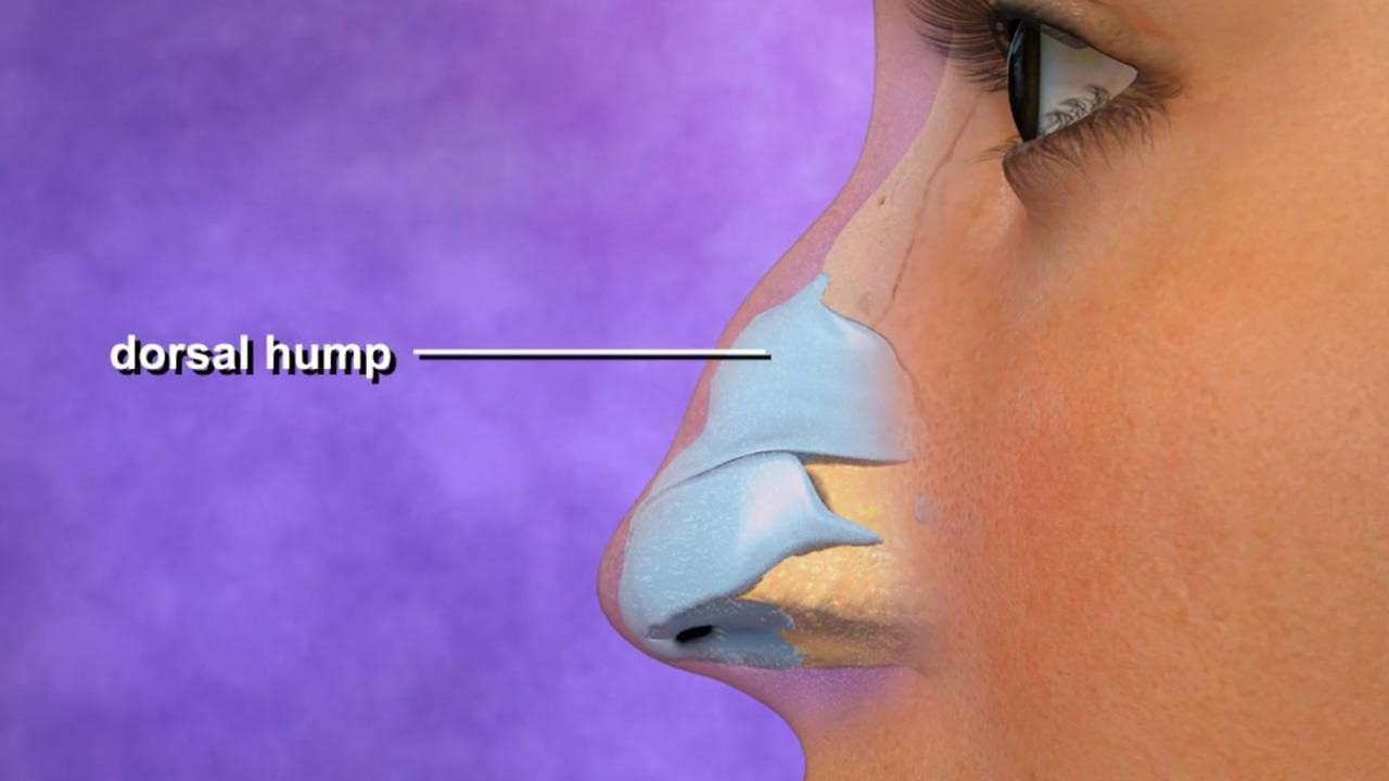 revision rhinoplasty expert los angeles