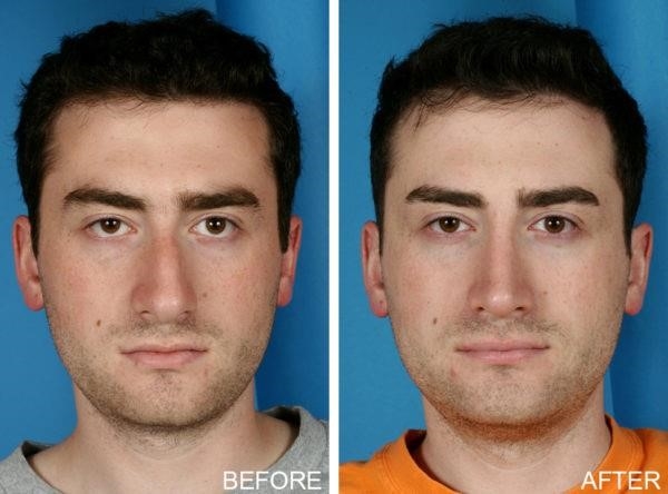 revision rhinoplasty expert los angeles