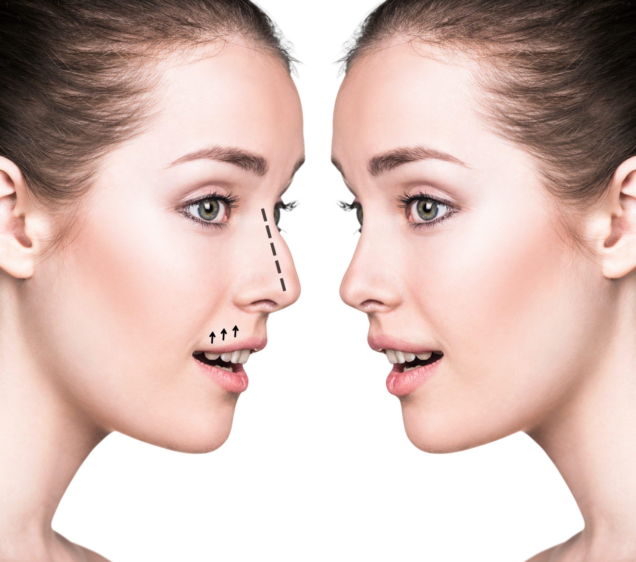 rhinoplasty experts